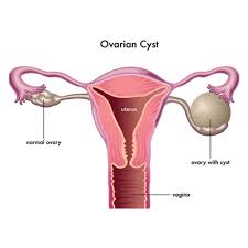 Ovarian Cyst Removal $2200